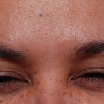 smooth skin after dysport