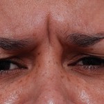 wrinkles before dysport