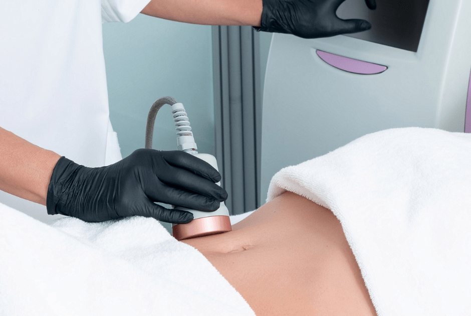 cool sculpting treatment