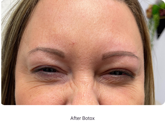 After Botox