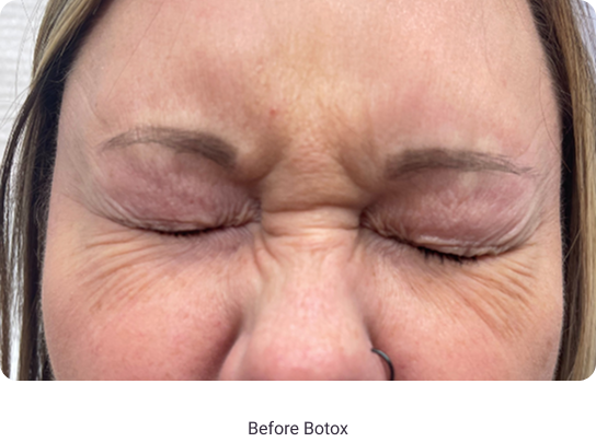 Before Botox
